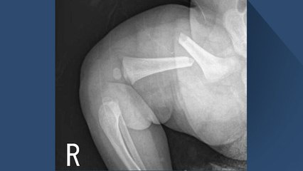 50일된 아기 뼈가 이렇게 부러지려면... / YTN