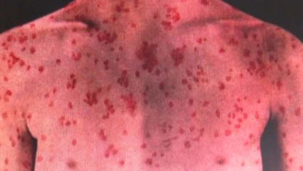 홍역, ‘2030'...젊은 층 취약 이유는? / YTN