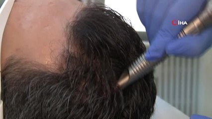 Saç Dökülmesine Siyah Sarımsak Şifası"