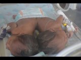 Mother to conjoined twin girls celebrates successful separation