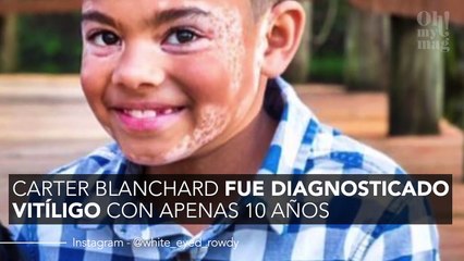 Superó la depresión por el vitíligo gracias a un perro con la misma dolencia