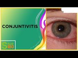 Conjuntivitis: síntomas y tratamiento | Salud180