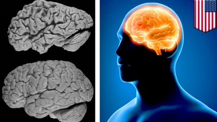 Memory loss in Alzheimer's patients could be reversed