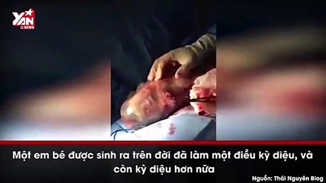 Em bé ra đời nguyên bọc ối, khò khò ngủ say mặc bác sĩ vần vò