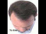 what causes baldness