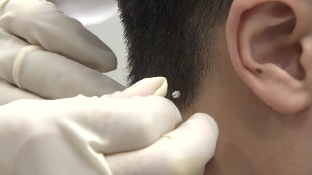 매선침, 만성 목 통증 치료 효과 과학적 입증 / YTN