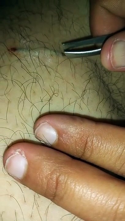 Taking splinters out ( 720 X 406 )