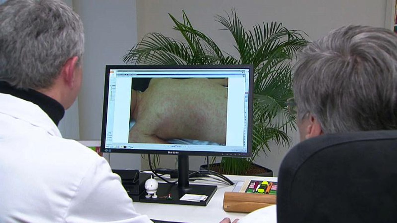 13 Fälle bestätigt: Grazer Kinderambulanz kämpft gegen Masernausbruch