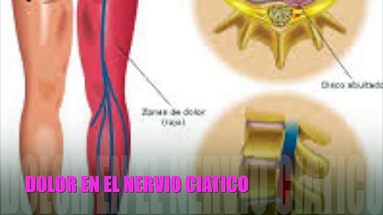 Como Eliminar el Dolor del Nervio Ciatico, con Remedios Caseros, Facil y Barato