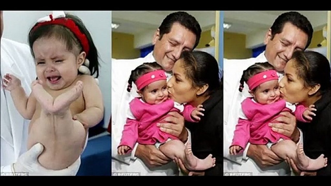 Seorang Ibu di India Lahirkan Bayi Berfisik Putri Duyung