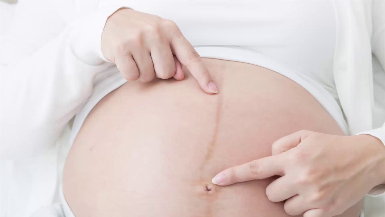 Tout savoir sur la ligne brune sur le ventre pendant la grossesse