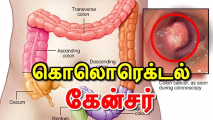 கொலொரெக்டல் கேன்சர் # colon cancer # cancer # Dr. Manikandan