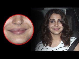 Bollywood Actress Anushka Sharma's Lip Surgery Gone Wrong Again!