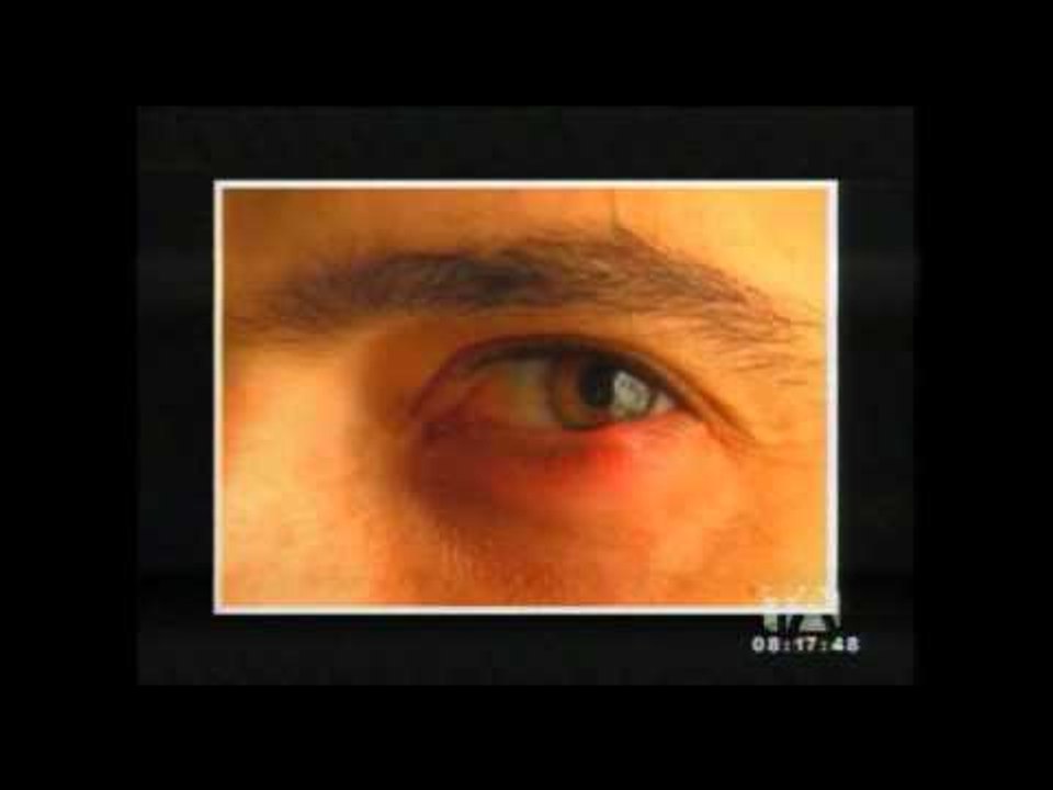 ¿Qué genera un orzuelo, cómo evitarlo y que deb...