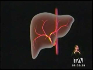 Se realizó el primer trasplante hepático con donante vivo en el sector público