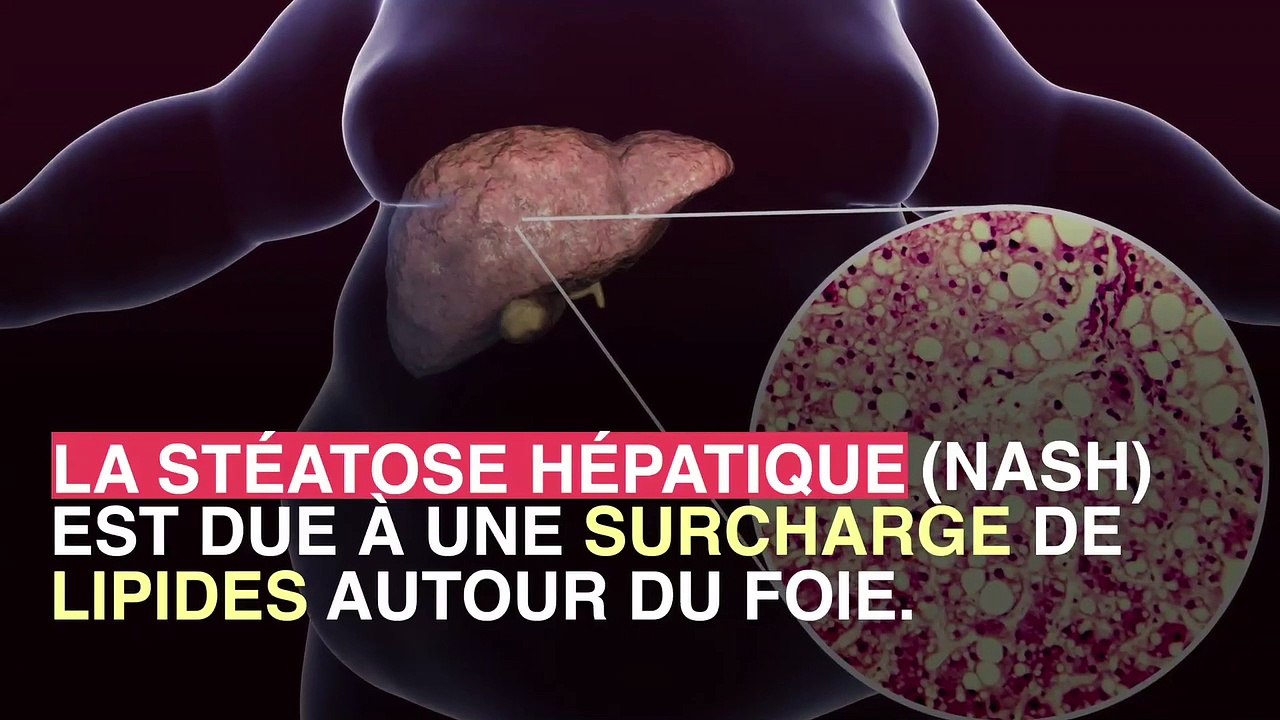 Maladie du foie : comment le sucre peut jouer un rôle dans certaines cirrhoses