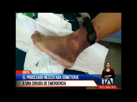 Procesado con grillete electrónico necesitaba retirarlo para operarse -Teleamazonas