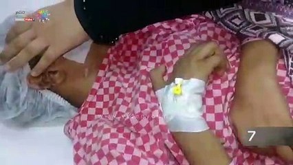 "فرح" طفلة بين الحياة والموت.. تحولت حياتها لجحيم بسبب فتحة أسانسير