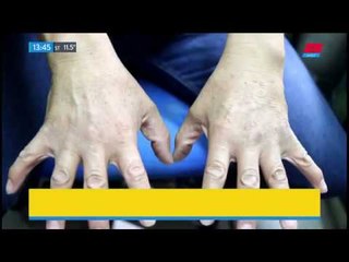 Con bienestar: Los mitos de la osteoporosis