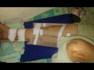 Chaco: enyesan pacientes con cartón