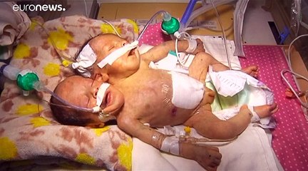 وفاة توأمين ملتصقين باليمن كانا بحاجة للعلاج خارج البلاد