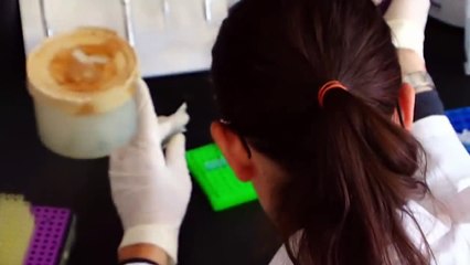 The Woman Whose Legs Turned Black - Cryoglobulinemia (Medical Documentary)