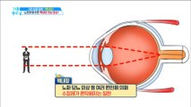[HEALTH] Possible blindness disease, 