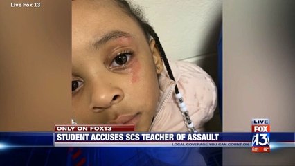 'Tattletaling' Memphis Kindergarten Girl Smacked In Face With Ruler