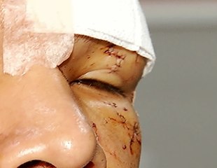 Por poco pierde la vista luego de ser agredido por su propio amigo