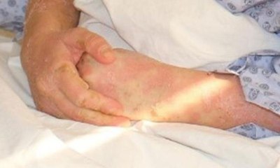 Ağrı kesici ilaçtan sonra bütün vücudu yaralar içinde kaldı