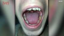 Man Claims Drinking 6 Energy Drinks A Day Ruined His Teeth