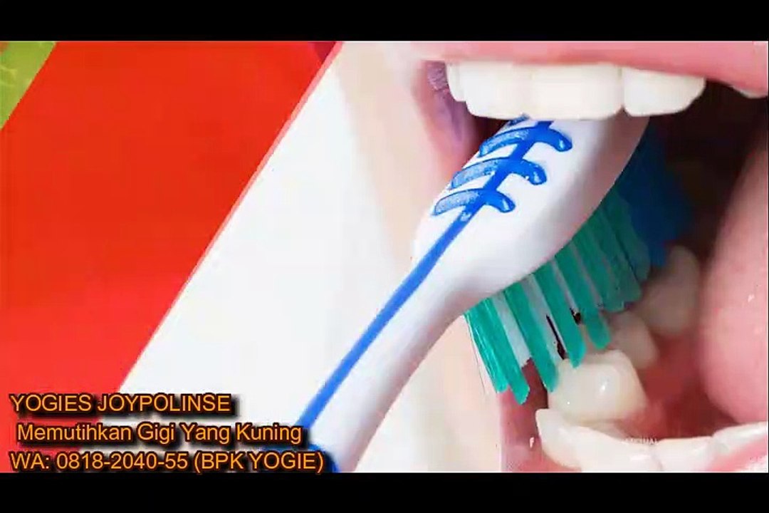 PROMO!! 0818-2040-55 | Yogies Joypolinse Tanjung Jabung Timur, Memutihkan Gigi Yang Kuning