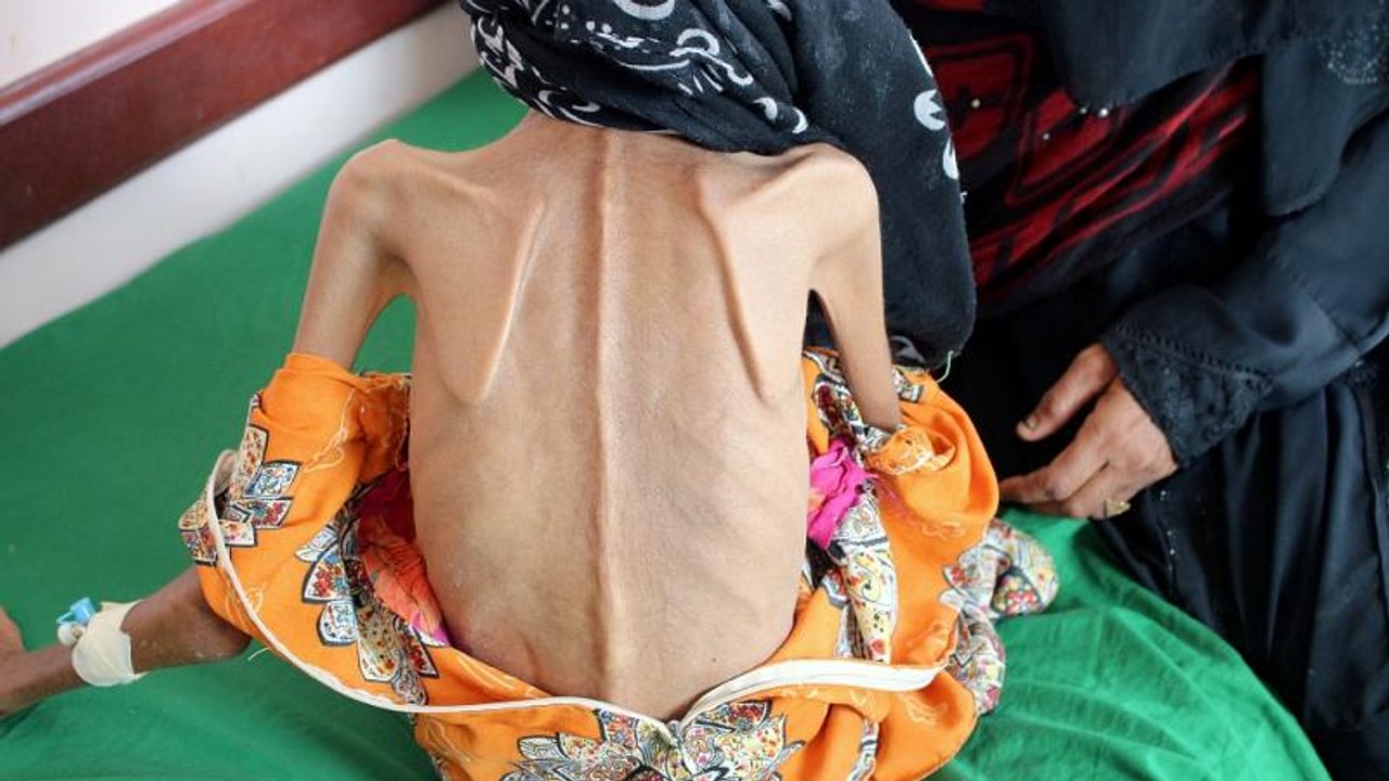 Starving girl shows devastating impact of Yemeni war