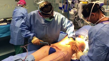 Fixing Asymmetry After Hourglass Hip Surgery ✨