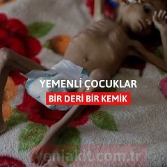 Yemenli çocuklar bir deri bir kemik