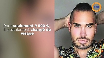 Cet homme change totalement de visage avec la chirurgie !