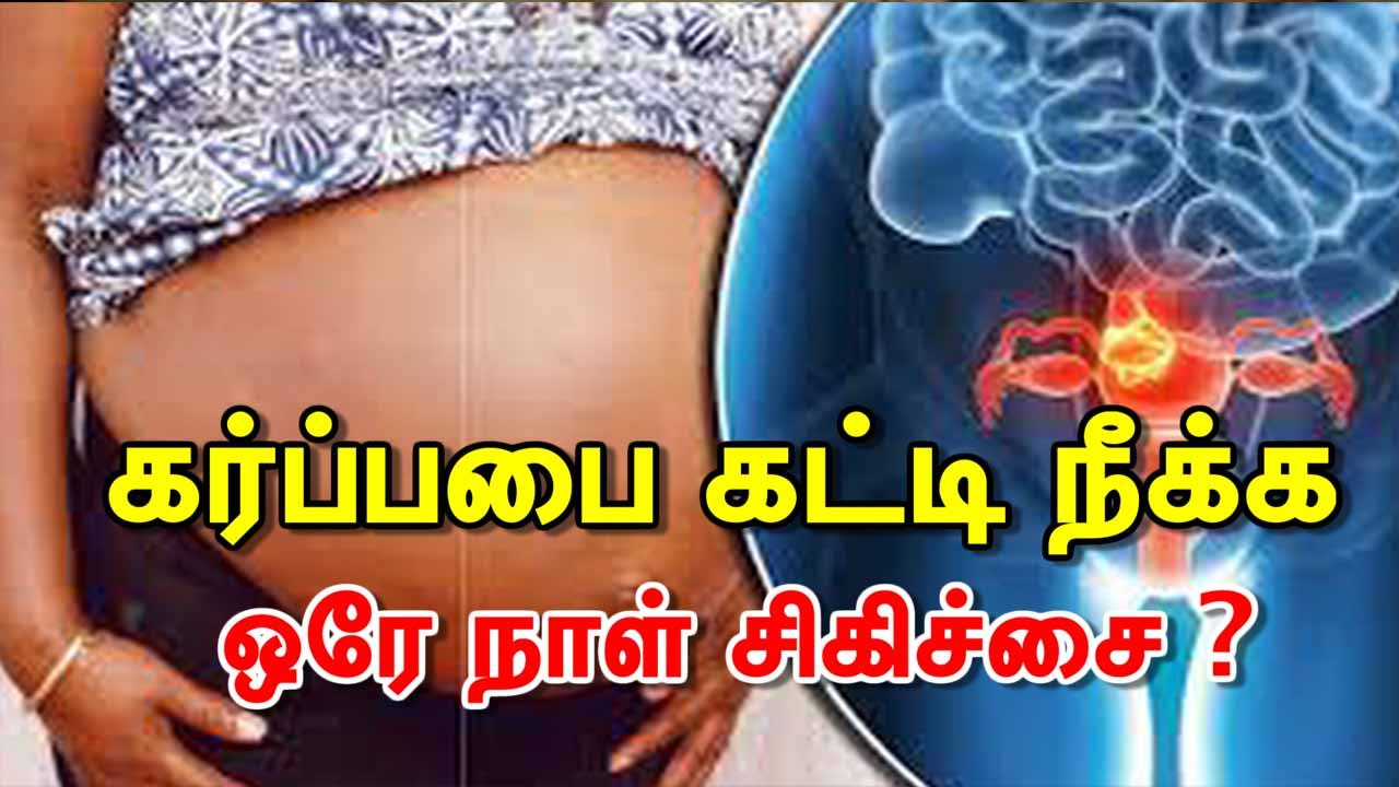 கர்ப்பபை கட்டி நீக்க ஒரே நாள் சிகிச்சை ?