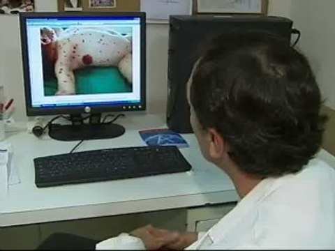 Un medicamento contra el cáncer cura a un niño con una enfermedad 'rara' en la piel