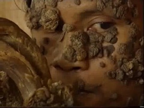 Una rara enfermedad convierte a un indonesio en un hombre árbol