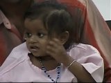 ??xito de la operación a la niña india que nació con cuatro brazos y cuatro piernas