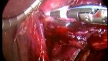 Heller myotomy