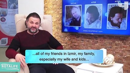 Excellent Results in Hair Transplant