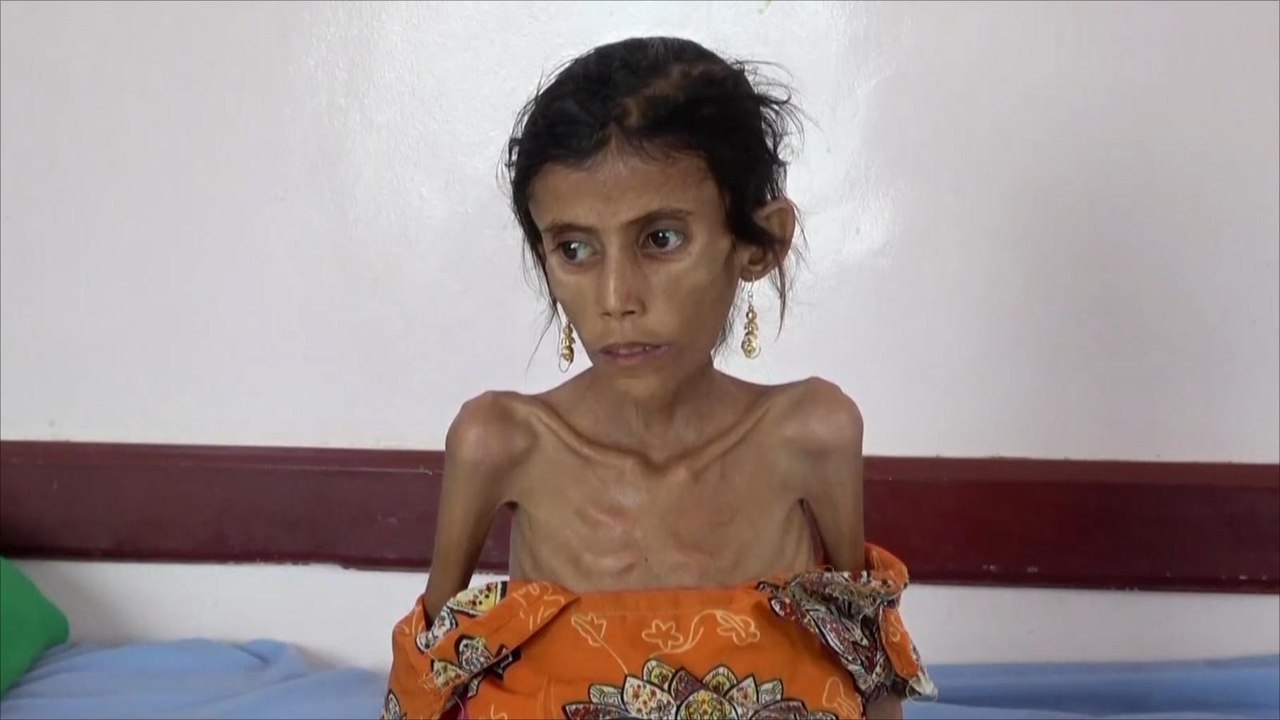 الجوع وسوء التغذية يفتكان بأطفال اليمن