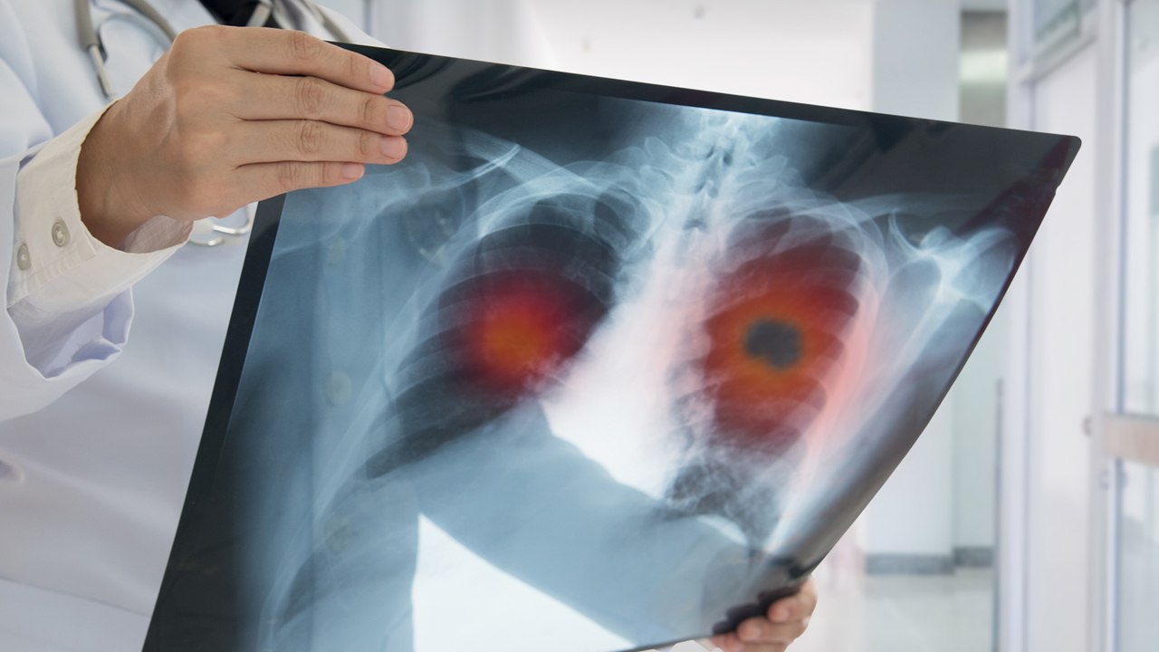 Easy Ways to Reduce Your Risk of Getting Cancer