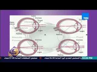 عسل أبيض | 3asal Abyad - كيفية الرؤية عند المريض بقصر وطول النظر
