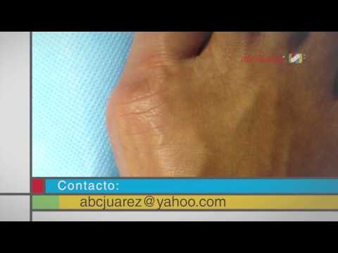 ¿Cómo es el procedimiento para tratar los juanetes?