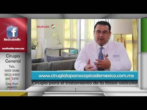 016 CUANDA ES NECESARIA UNA CIRUGIA ARA EL TRATAMIENTO DE LA LITIASIS VESICULAR