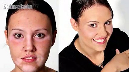 Areola Reconstruction ve Vitiligo uygulaması