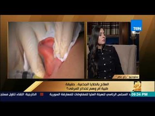 رأى عام - صدفة وراء اكتشاف العلاج بالخلايا الجذعية