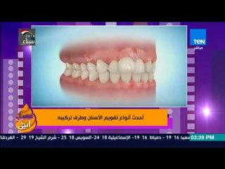 عسل أبيض - فقرة حول أحدث أنواع تقويم الأسنان وطرق تركيبه مع أخصائي التقويم طارق الأشقر